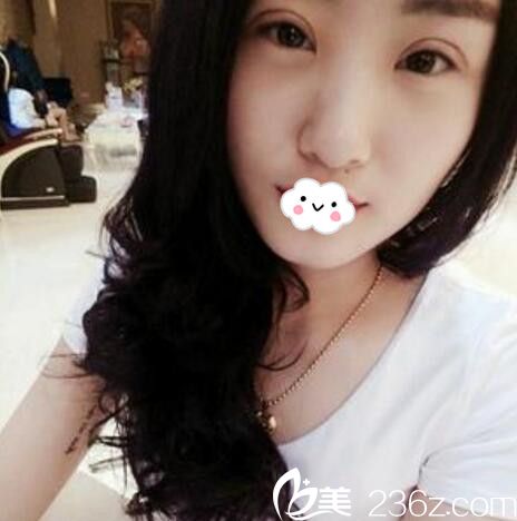 淮北微悦(伊尔美)医疗美容门诊部胡斌全切双眼皮术后效果 淮北微悦(伊尔美)医疗美容门诊部胡斌全切双眼皮术后效果