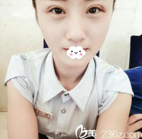 淮北微悦(伊尔美)医疗美容门诊部胡斌全切双眼皮案例 淮北微悦(伊尔美)医疗美容门诊部胡斌全切双眼皮案例