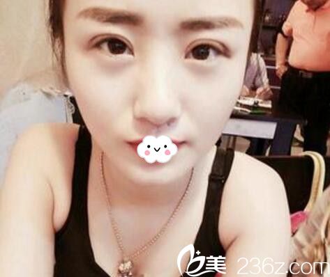 淮北微悦(伊尔美)医疗美容门诊部整形美容医院全切双眼皮术后1月 淮北微悦(伊尔美)医疗美容门诊部整形美容医院全切双眼皮术后1月