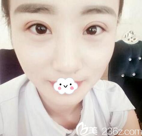 闺蜜说淮北微悦胡斌手术好 带我来做全切双眼皮真实体验！