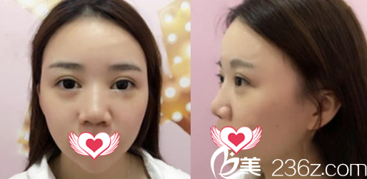 在蚌埠国色整形美容医院做硅胶假体隆鼻+鼻小柱延长+鼻尖抬高鼻综合隆鼻术前照片 在蚌埠国色整形美容医院做硅胶假体隆鼻+鼻小柱延长+鼻尖抬高鼻综合隆鼻术前照片