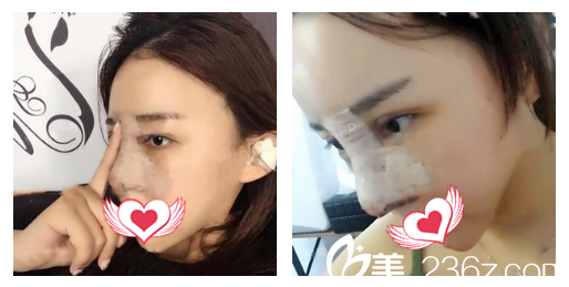 安徽蚌埠国色整形美容医院做鼻综合隆鼻术后即刻样子 安徽蚌埠国色整形美容医院做鼻综合隆鼻术后即刻样子