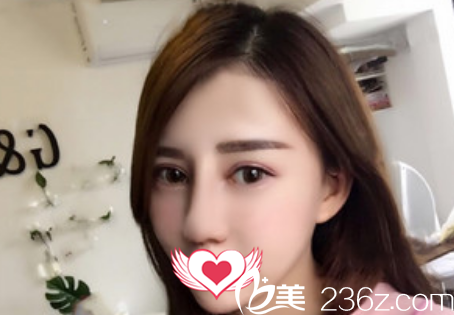 蚌埠国色整形美容医院做鼻综合隆鼻术后第9天拆线后恢复情况展示 蚌埠国色整形美容医院做鼻综合隆鼻术后第9天拆线后恢复情况展示