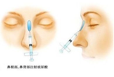 玻尿酸隆鼻过程