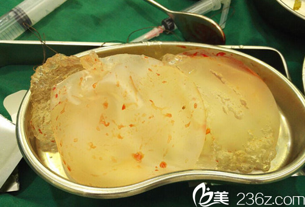 以前做的假体隆胸发生渗漏 我在南充达芬奇找董茂林做了隆胸假体取出