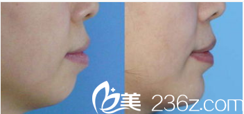 韩国LK整形外科医院案例 韩国LK整形外科医院案例