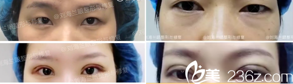 成都刘辅容眼整形于修复研究院刘海兰双眼皮案例