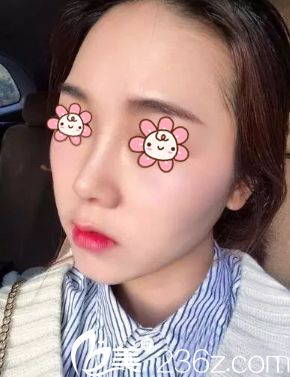 鼻综合10天 鼻综合10天