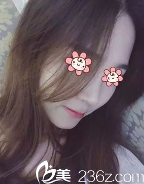 基本消肿了 基本消肿了