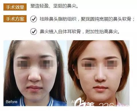 宁波艺星肖庆华医生隆鼻<span style=