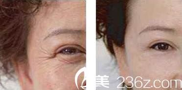 美亚整形医院注射祛除眼角纹案例术前术后对比图