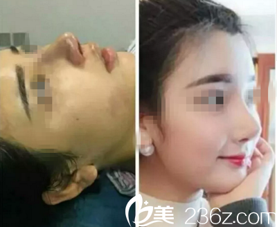 术前术后对比图