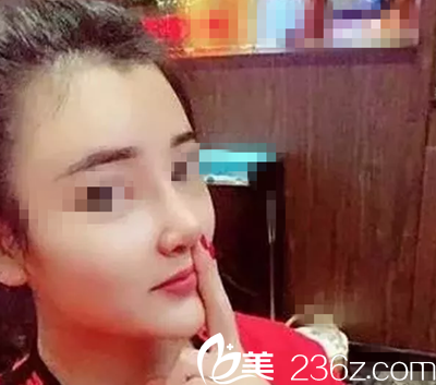 术后22天