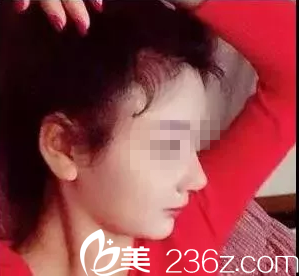 术后33天