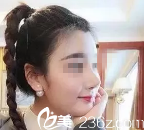 常德伊丽莎白卢开锐院长给我做的鼻失败修复两个月恢复过程