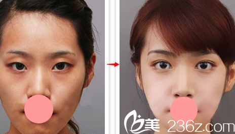 美亚整形医院韩式双眼皮案例术前术后对比图