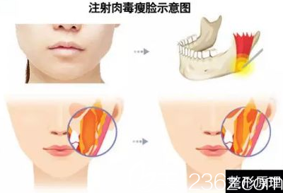 医生解析瘦脸的原理 医生解析瘦脸的原理
