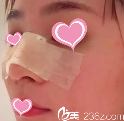 术后第三天的样子 术后第三天的样子