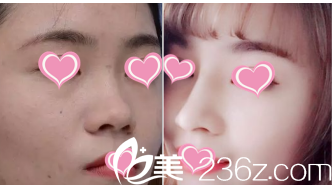 术前术后对比图 术前术后对比图