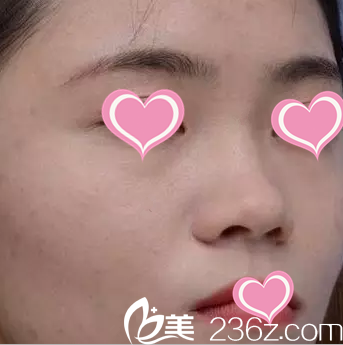 术前照片 术前照片