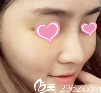 术后一个月的照片 术后一个月的照片