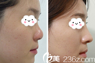 东营艺美李琳隆鼻案例前后对比 东营艺美李琳隆鼻案例前后对比