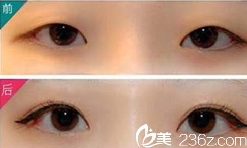 雅美整形高建红医生韩式双眼皮案例对比图