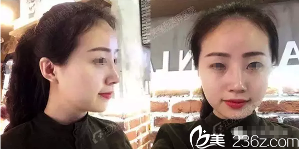 拆线术后恢复中