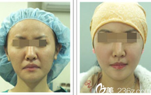 韩国美人制造整形医院颧骨手术案例