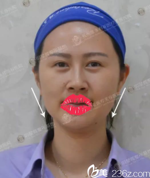 做面部线雕提升前照片 做面部线雕提升前照片