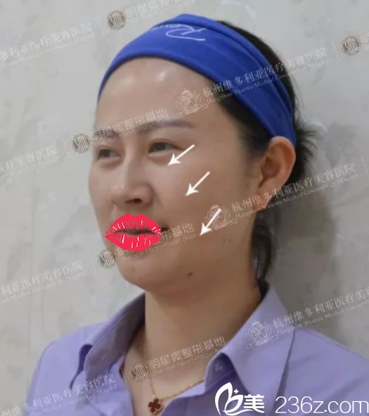 到维多利亚做线雕前侧面照 到维多利亚做线雕前侧面照