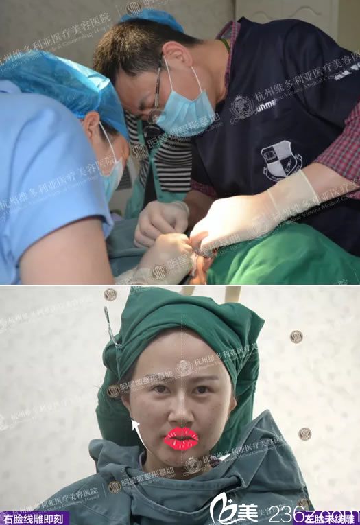 程健院长做线雕手术过程 程健院长做线雕手术过程