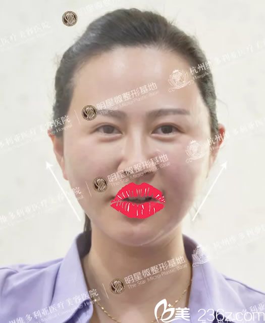 面部线雕提升术后即刻效果图 面部线雕提升术后即刻效果图