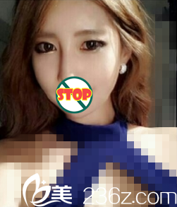 颧骨整形术后2个月<span style=