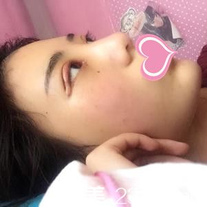 <!--<i data=20240703-sp></i>-->易院玲双眼皮手术案例 <!--<i data=20240703-sp></i>-->易院玲双眼皮手术案例