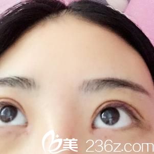 双眼皮手术后第7天 双眼皮手术后第7天