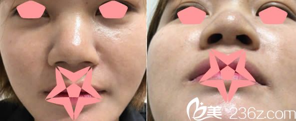 在福州玛恩整形医院做鼻子术前照 在福州玛恩整形医院做鼻子术前照