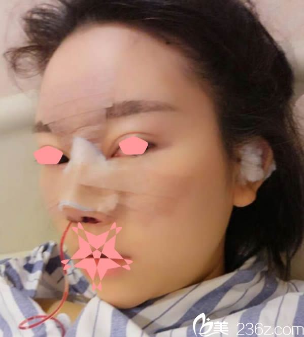 做完鼻综合手术第1天的样子 做完鼻综合手术第1天的样子