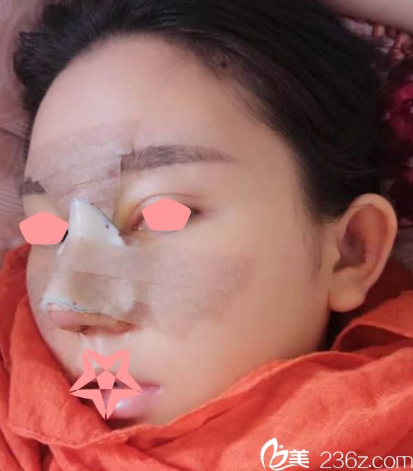 综合隆鼻术后第4天 综合隆鼻术后第4天