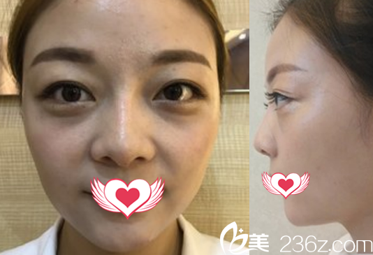 没有去亳州缔美做全脸自体脂肪填充前的样子 没有去亳州缔美做全脸自体脂肪填充前的样子