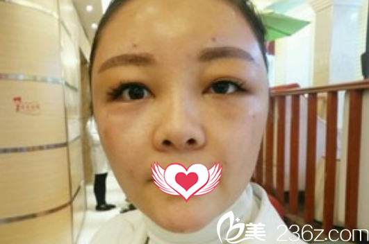 在亳州缔美整形做自体脂肪能填充面部术后第1天恢复情况 在亳州缔美整形做自体脂肪能填充面部术后第1天恢复情况