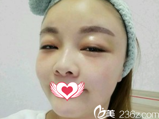 找亳州缔美邢志平做自体脂肪填充面部术后第6天恢复效果展示 找亳州缔美邢志平做自体脂肪填充面部术后第6天恢复效果展示