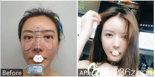 深圳科美丽格徐斌双眼皮失败修复加隆鼻和脂肪填充案例