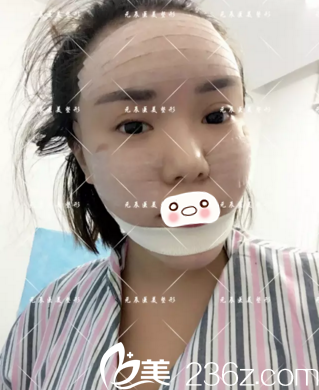 术后天效果 术后天效果