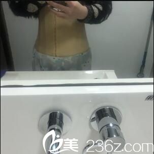 上海微蓝医疗美容门诊部林楠吸脂瘦腰真人案例术后第五天