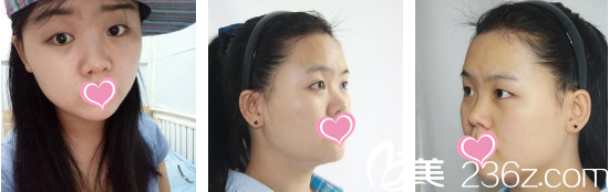 西安叶子医院双眼皮真实<span style= 西安叶子医院双眼皮真实<span style=