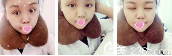 朱健康医生双眼皮<span style=