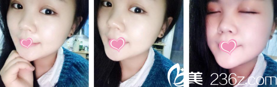 西安叶子医院双眼皮术后恢复第10天 西安叶子医院双眼皮术后恢复第10天