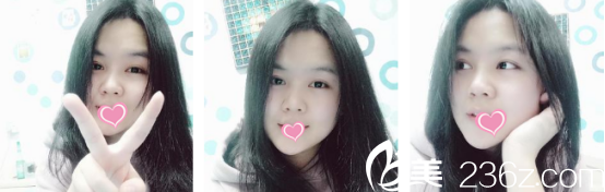 术后20天的样子 术后20天的样子