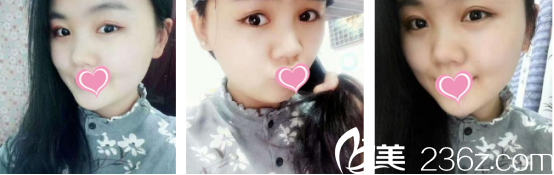 西安叶子整形医院朱健康做双眼皮+开眼角效果真的挺不错的